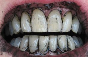 Темный зуб во сне. Черные передние зубы. К чему снится гнилой зуб